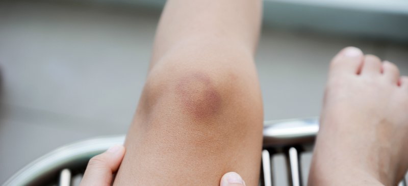 How to Get Rid of Bruises: 10 Natural Bruise Remedies