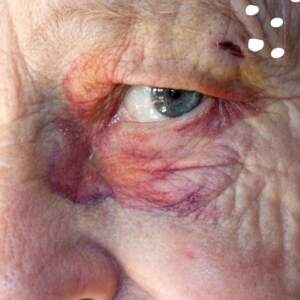 hematoma over the eye