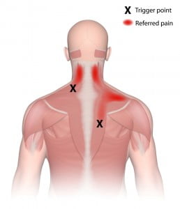 what is a trigger point