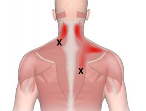 Are you trapped in pain? | Shoulder and Trapezius Pain Relief