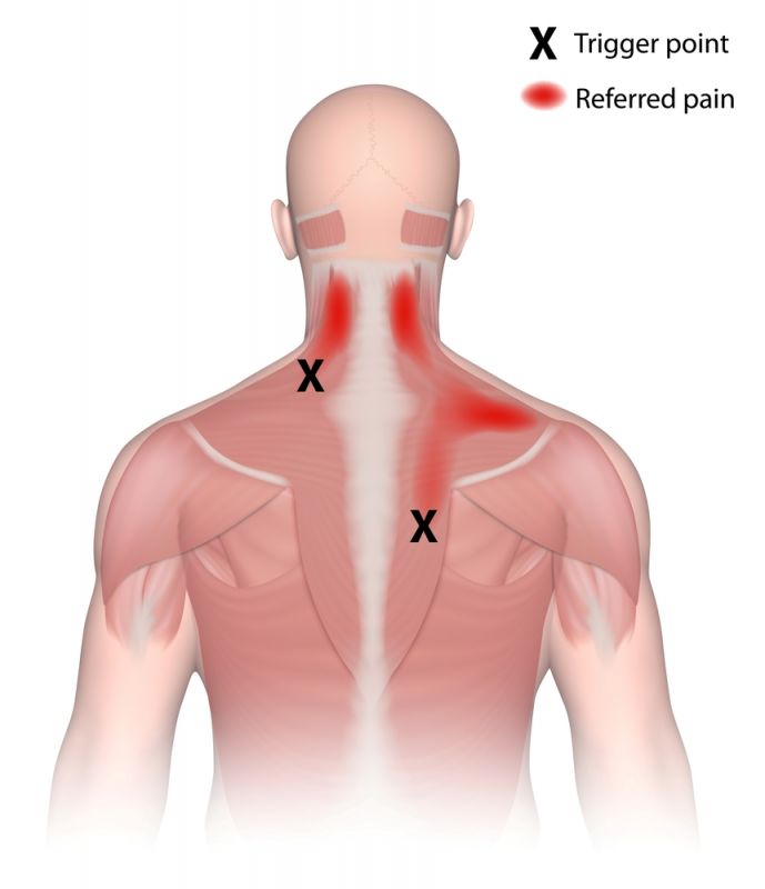 serratus posterior trigger point