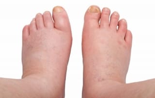 Massage FAQ- Why do some people swell more