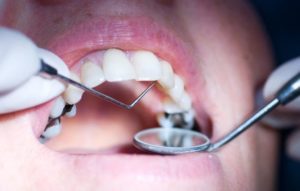 Your Old Dental Fillings Probably Contain Mercury—Are They Dangerous?