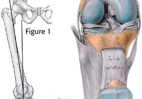 The Role of the Q Angle in Anterior Knee Pain