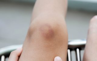 How to Get Rid of Bruises: 10 Natural Bruise Remedies