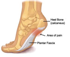Plantar Fasciitis Treatment: The Complete Guide 2017