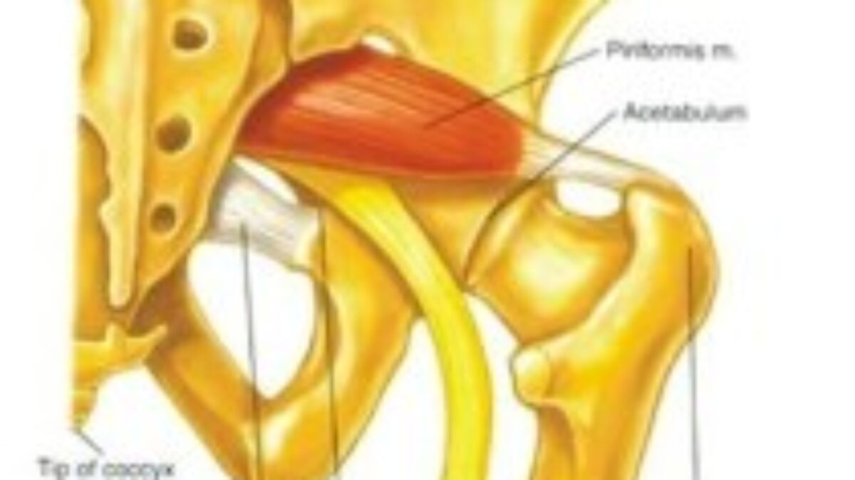 Pain In The Butt Piriformis Syndrome