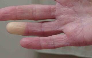 white fingers and toes in raynaud's phenomenon