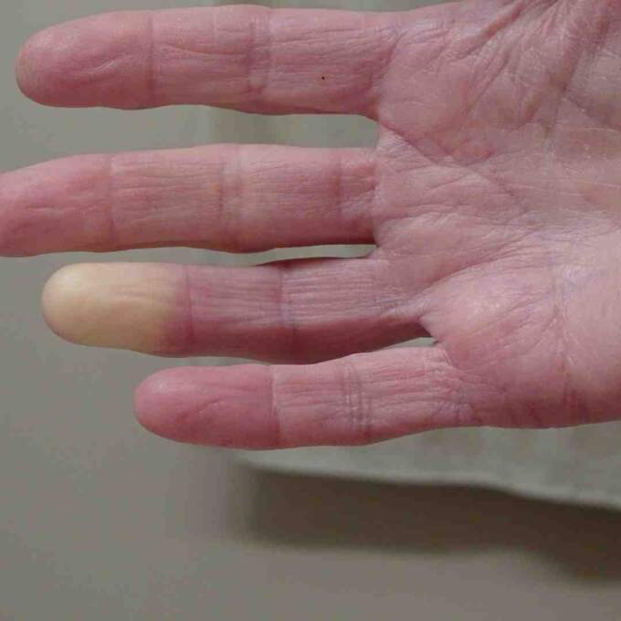 white fingers and toes in raynaud's phenomenon