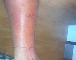 bacterial skin infection