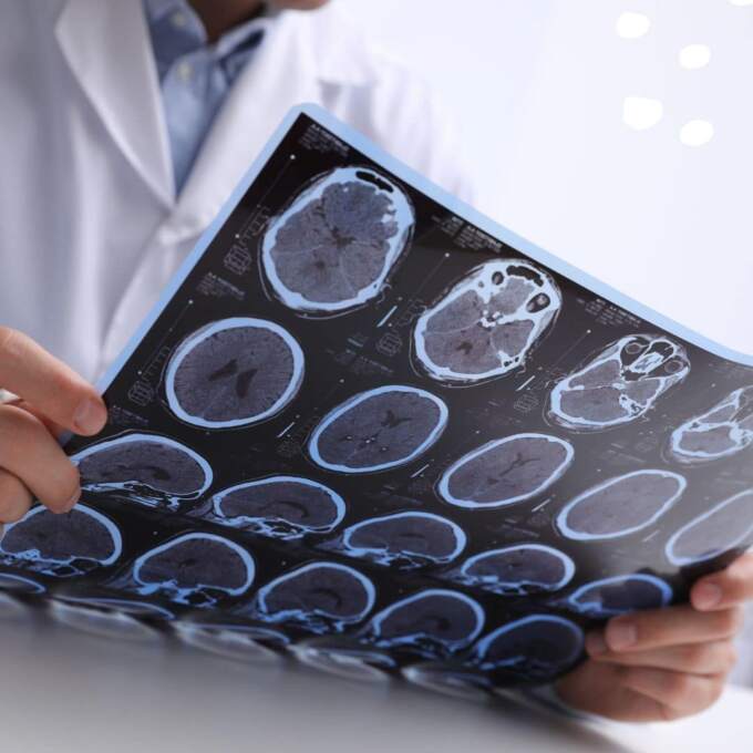 brain scans for multiple sclerosis