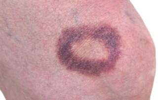 minor hematoma