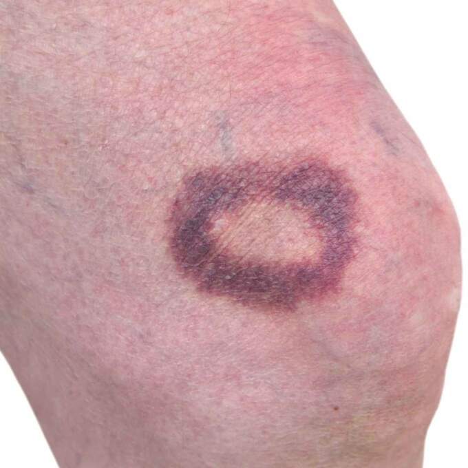 What Is A Hematoma And How Is It Treated?