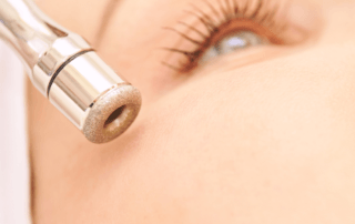 microdermabrasion treatment columbus, ohio