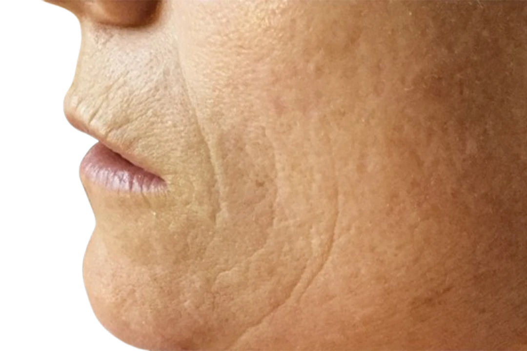 cheek before microneedling pickerington