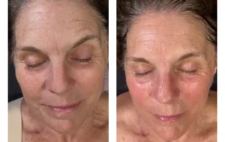 Before and after of a hydrafacial in pickerington