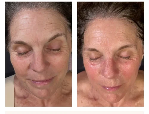 What Does a HydraFacial Do for Your Face? | Pickerington