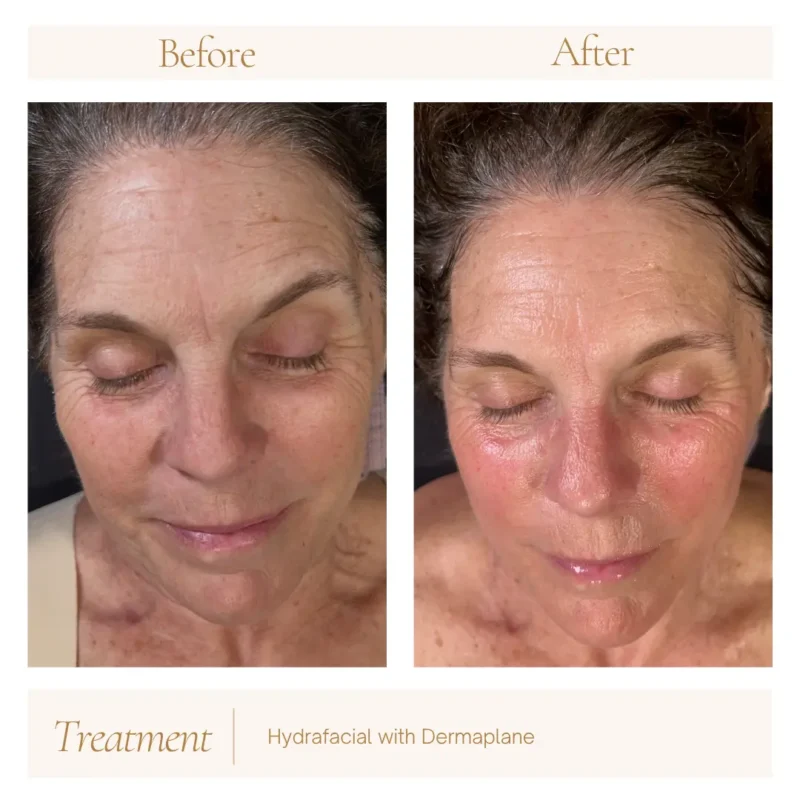 Neutral Before and After Instagram Post Before and after of a hydrafacial in pickerington